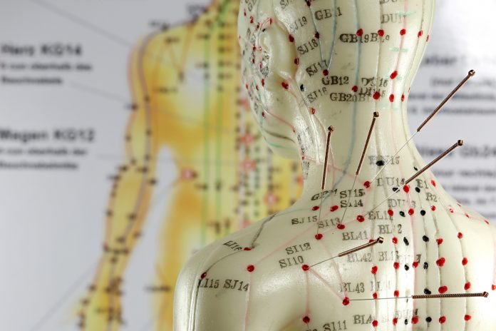 female acupuncture model with needles in the shoulder