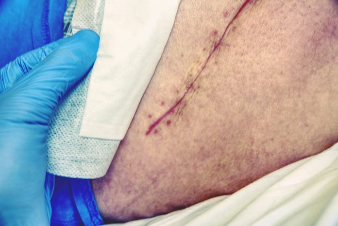 Patient with a fresh long scar after a hip surgery. Macro, Human leg