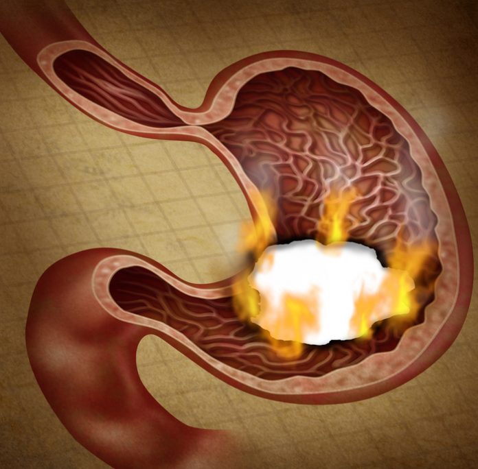 Stomach Ulcer
