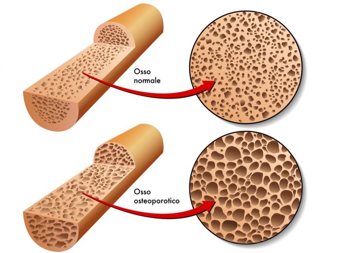 Fotolia_bones_osteoporosis