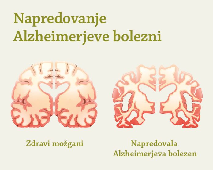 Napredovanje_Alzheimerjeve_bolezni